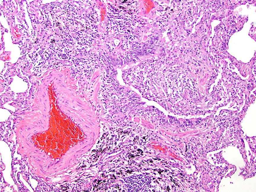 AN APPROACH TO BIOPSY DIAGNOSIS Interpretation of biopsies in this setting is difficult since granulomas occur in a wide array of disease processes.