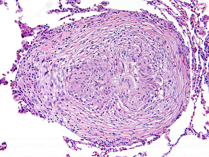 Hypersensitivity Pneumonitis 197 Fig. 13. Sarcoidosis. In contrast to the granulomas in hypersensitivity pneumonitis (see Fig.
