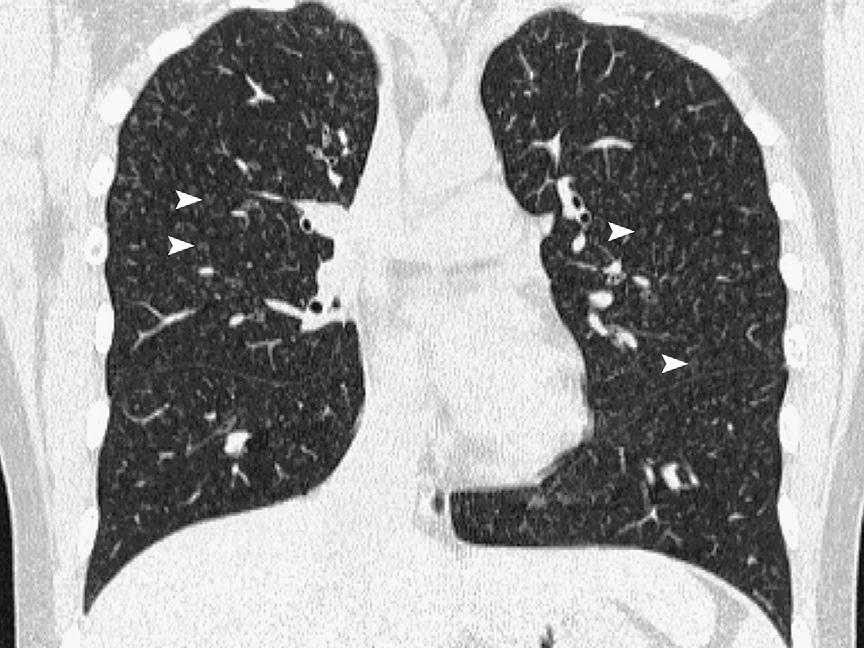 HRCT has replaced the plain chest radiograph as the primary diagnostic imaging modality in patients with hypersensitivity pneumonitis because of its sensitivity and specificity.