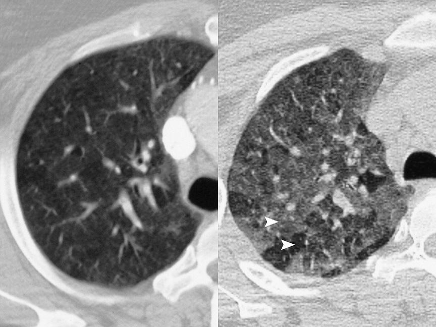 The image on the right acquired through the same region during the expiratory phase of respiration demonstrates marked accentuation of density differences between secondary pulmonary lobules