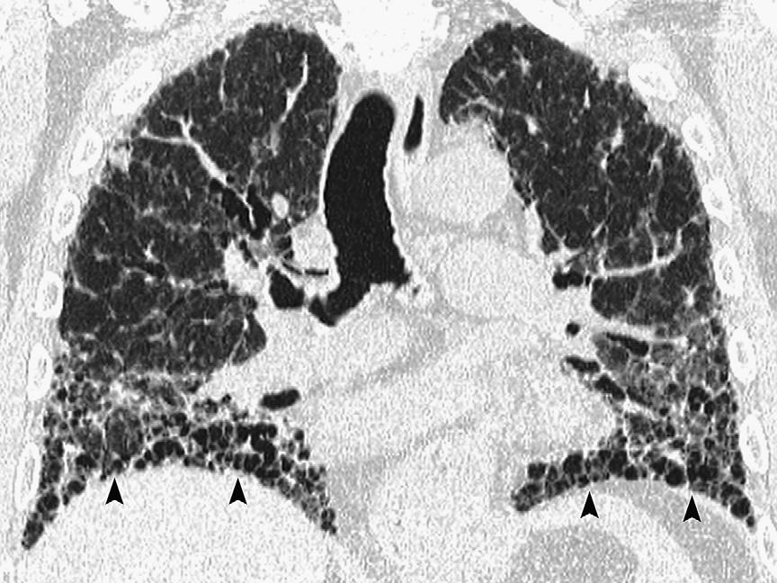 There is distortion and dilatation of middle and upper lung zone airways (within area defined by arrowheads), called traction bronchiectasis, which indicates the presence of surrounding fibrosis.