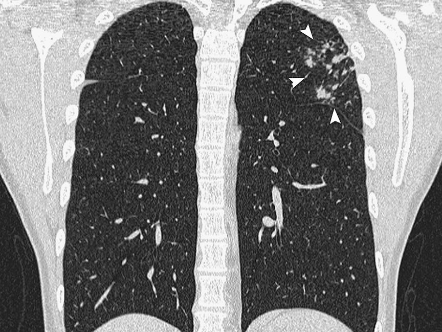 Hypersensitivity Pneumonitis 193 Fig. 7. Active infection with Mycobacterium tuberculosis.