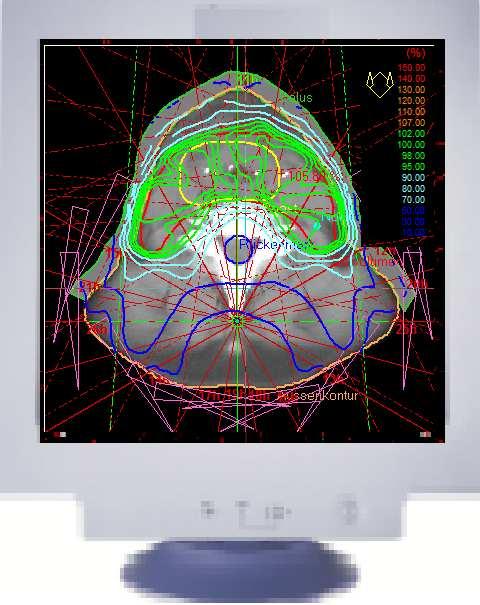 3-D-Treatment planning process (Optimized dose Distribution) Fixing of the treatment position (positioning, immobilization) MRT CT PET SPECT Fusion Contouring