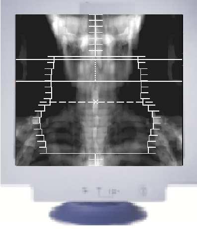 3-D-Treatment planning process (Simulation) Fixing of the treatment position (positioning, immobilization) Simulation MRT CT PET SPECT Fusion