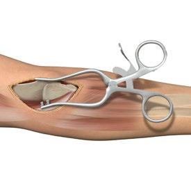 Carry dissection down sharply through the subcutaneous tissues and the triceps tendon. Care should be taken to avoid the ulnar nerve that sits medially to the olecranon.