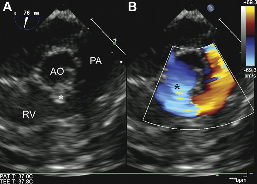 Ann Thorac Surg ZYBLEWSKI ET AL 2010;89:1990 4 TRANSESOPHAGEAL PROBE FOR SMALL INFANTS 1993 Fig 4. Simultaneous (A) 2-dimensional and (B) color-flow Doppler images are shown in a 3-week-old, 2.