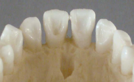 The teeth have wear facets but no carious lesions or significant dentin exposure.
