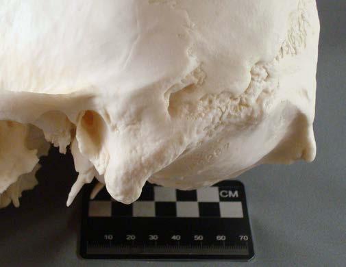 Figure 6: Skull, frontal view. The large supraorbital ridges and extremely masculine mandible are apparent.