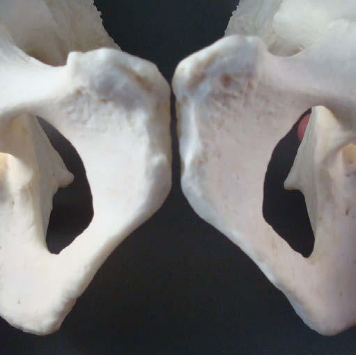 Postcranial: Figure 8: Ventral surface of the pubis, demonstrating masculine form The pelvis is typical of the male form. The greater sciatic notch is very narrow.