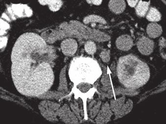A and B, CT images with (A) and without (B) contrast agent show apparent left upper pole mass (arrows) with hypoenhancement relative to renal parenchyma.