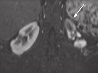 D and E, Dynamic contrast-enhanced MRI 1 week later shows slightly smaller lesion (arrows), with corticomedullary differentiation internally (D) and continued hypoenhancement relative to parenchyma