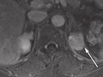 Focal pyelonephritis was diagnosed and resolved at follow-up MRI.