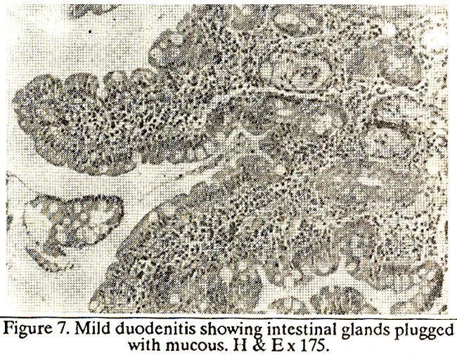 These blocked glands were interspersed between intestinal glands of normal appearance. In some cases, pools of mucus were seen outside the blocked glands in the lamina propria.