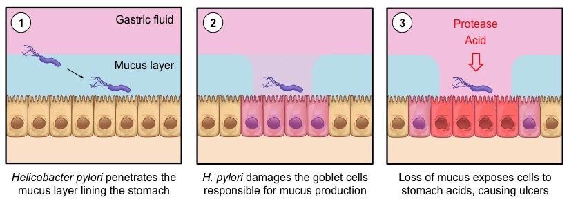 D.2.A3 Helicobacter pylori infection as a cause of stomach ulcers. Helicobacter pylori is a bacterium that can survive the acid conditions of the stomach by penetrating the mucus lining. H. pylori anchors to the epithelial lining of the stomach, underneath the mucus lining.