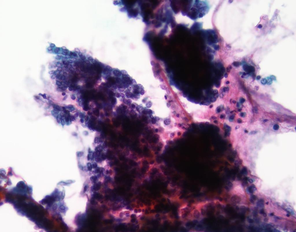 Case 4 - cytology 75 y.