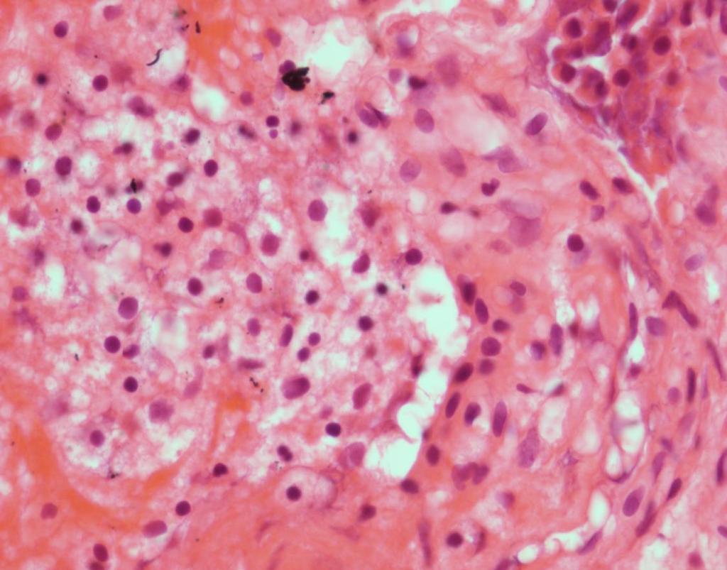 Case 5 - cytology Pancreatic cyst FNA
