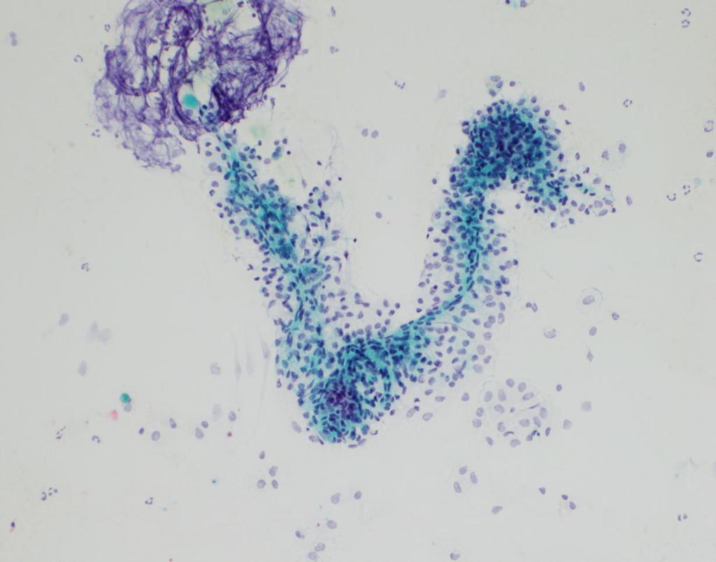 Case 6 - cytology Pancreatic cyst, FNA, 16 y.o. female Endoscopic ultrasounds. 2.6 cm pancreatic cyst?debris within it?