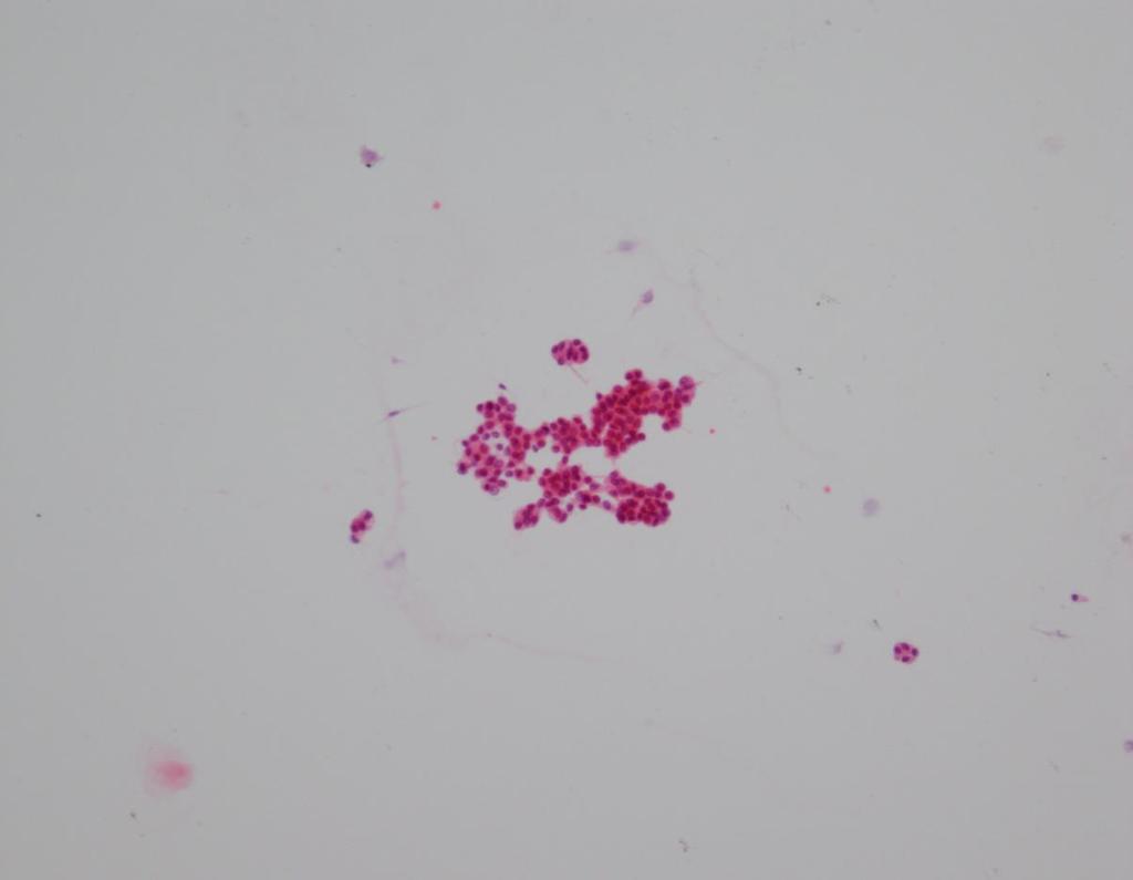 Case 8 - cytology Pancreatic cyst fluid FNA Query IPMN and