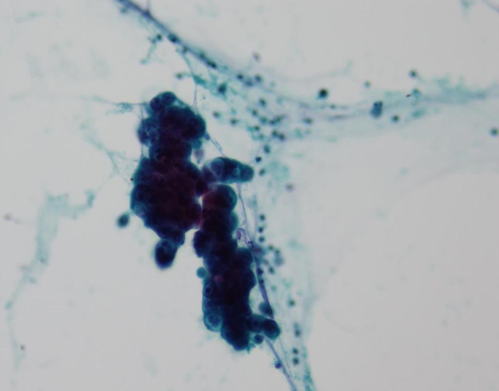 Case 10 - cytology 78 y.o, male Jaundice.