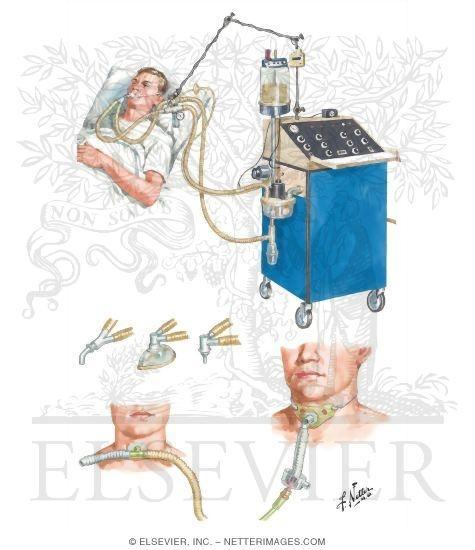 - The use of negative-pressure ventilators is restricted in clinical practice, however, because they limit positioning and movement and they lack adaptability to large or small body torsos.
