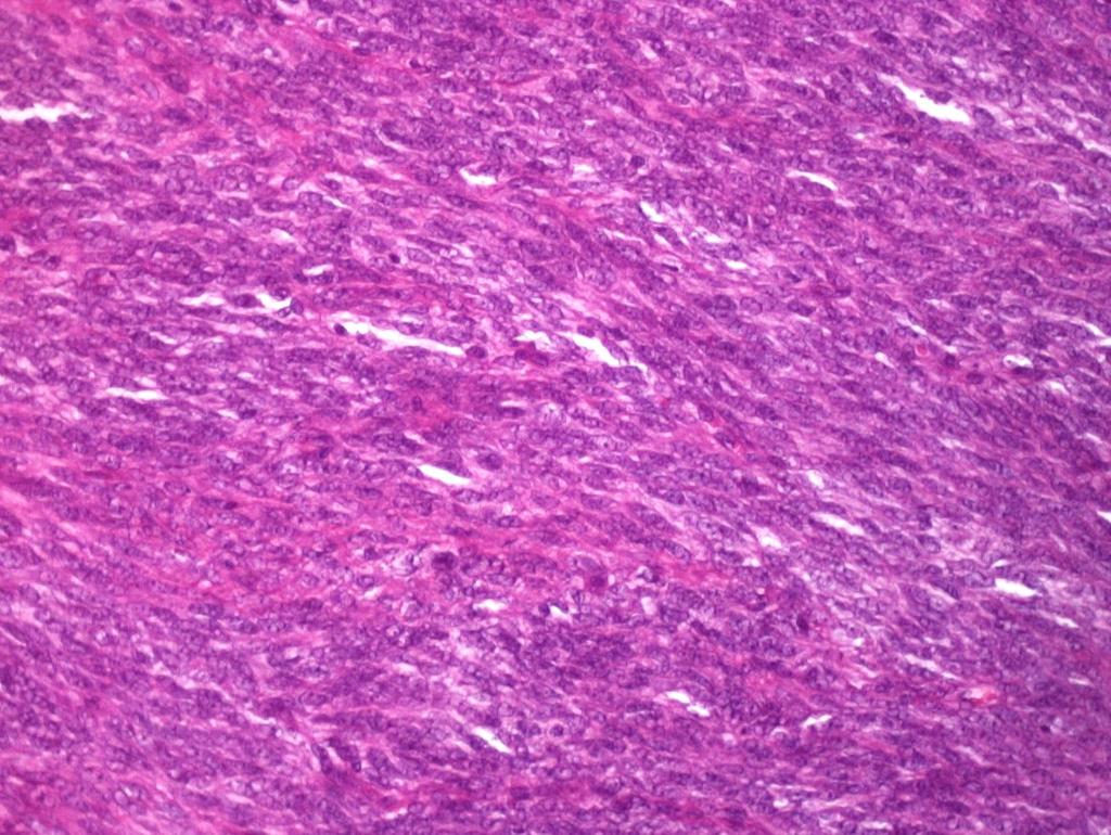histologic appearance. The tumors are composed of 2 morphologically distinct cell types: spindle cells and epithelioid cells.