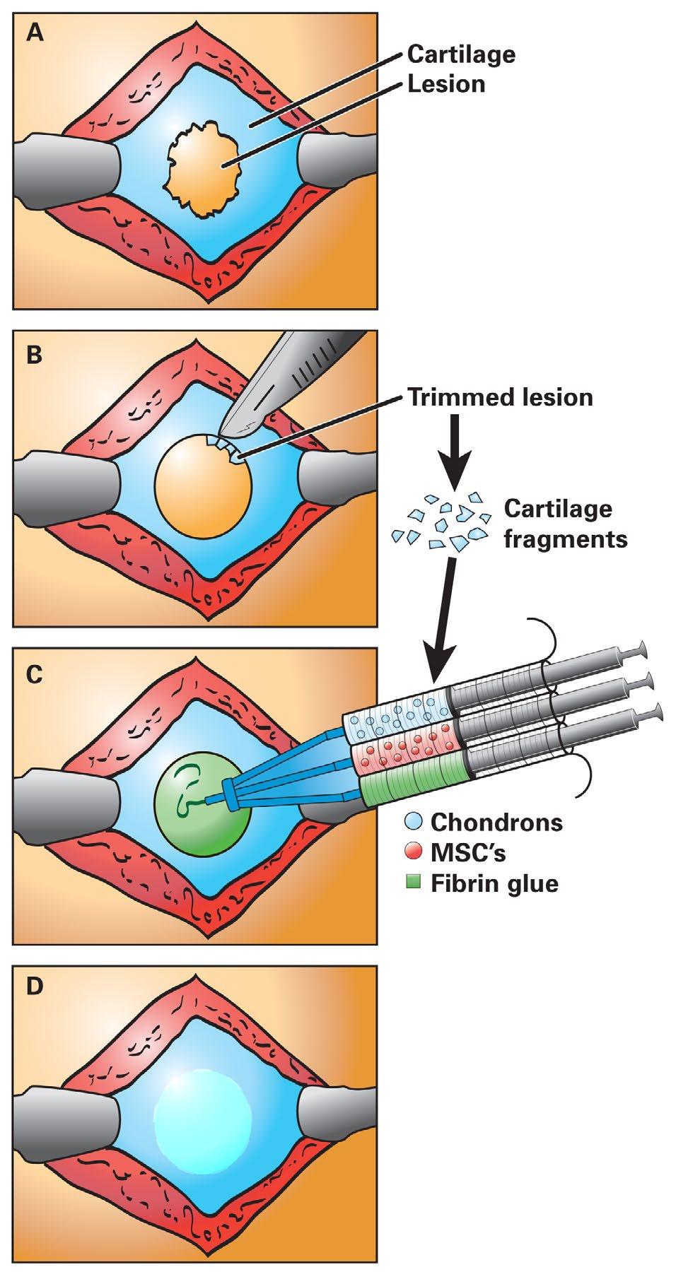 stem cells in fibrin glue were administered to patients using a simple 75-min protocol in the operating room (Bekkers et al., 2013) (Fig. 4).
