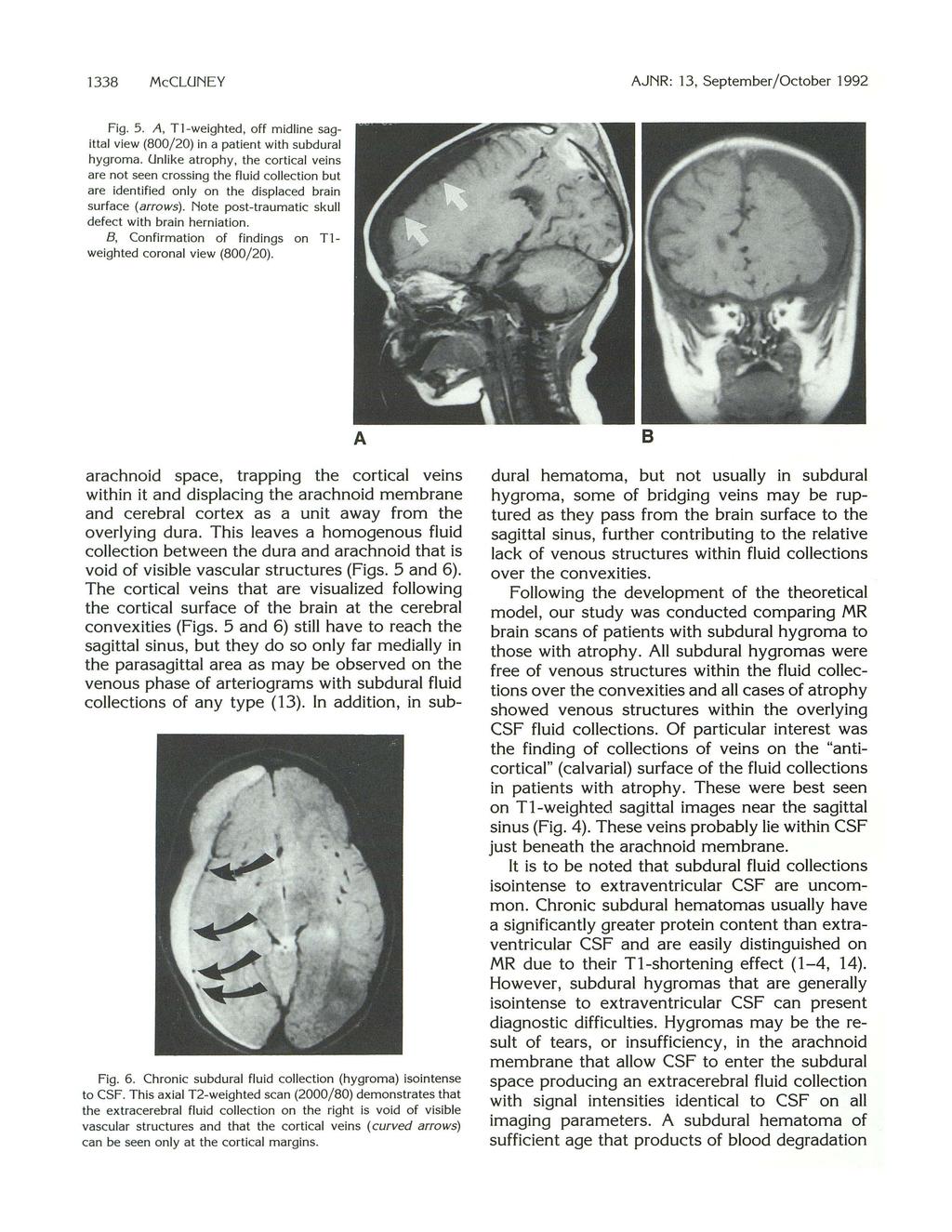 1338 McCLUNEY AJNR: 13, September / October 1992 Fig. 5. A, Tl -weighted, off midline sagittal view (800/20) in a patient with subdural hygroma.