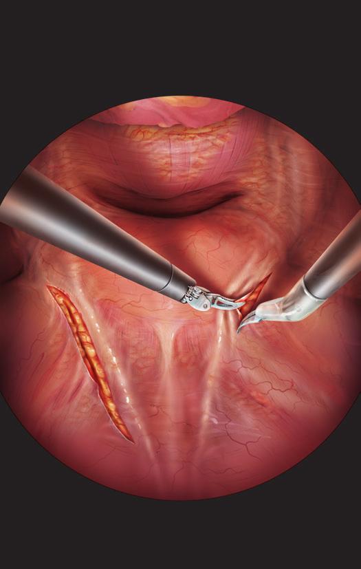 GILLITZER ET AL. Figure 3 After establishing pneumoperitoneum with a Veress needle, the 12-mm optic trocar is introduced and the abdomen inspected.