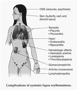 Systemic Lupus Erythematosus The kidney is a frequent target of injury in SLE.