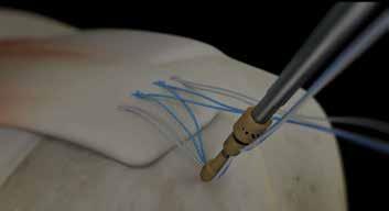 Advance until sutures can be clearly seen between the tissue and the pound-in tip.