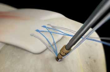 5 Place the pound-in tip at the desired location lateral to where the tendon is to be secured. Ensure the eyelet of the pound-in tip orients the sutures toward the tissue.
