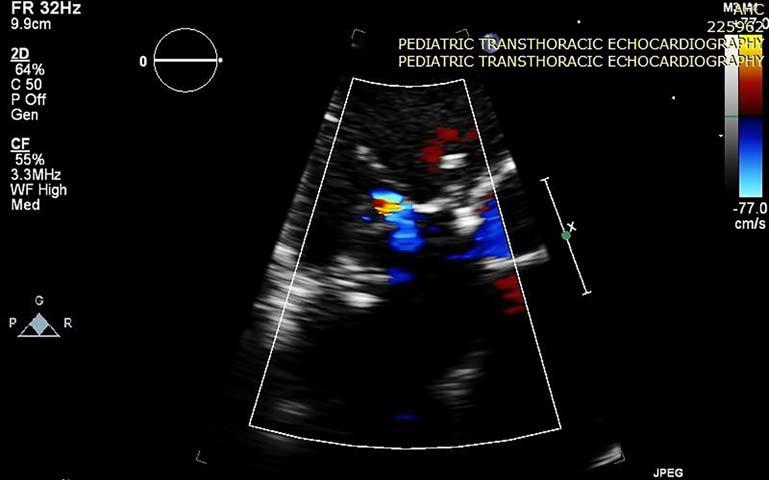 Page 5 of 5 Figure 6. Post-operative echocardiography showing trivial tricuspid regurgitation following the repair. the VSD.