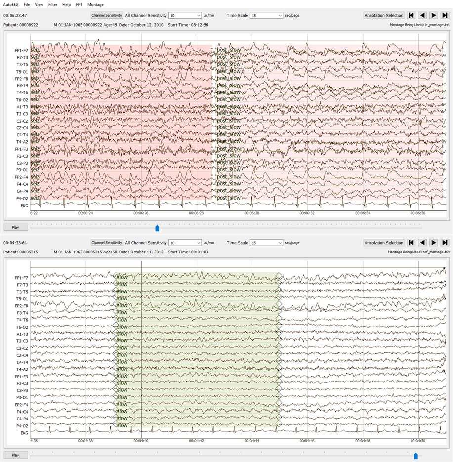 ELECTROENCEPHALOGRAPHIC SLOWING: A PRIMARY SOURCE OF ERROR IN AUTOMATIC SEIZURE DETECTION E. von Weltin, T. Ahsan, V. Shah, D. Jamshed, M. Golmohammadi, I. Obeid and J.