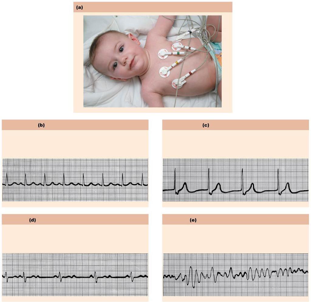 Figure 18.18 Normal and abnormal ECG tracings.