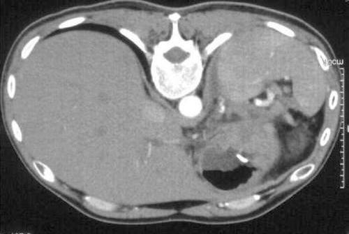Figure 3. Contrast-enhanced computerized tomography (CECT) of the abdomen at 6 weeks documents complete resolution of the intra-hepatic and the intra abdominal pseudocysts.