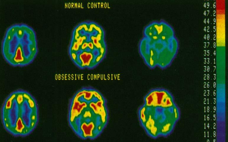 Obsessive-Compulsive Disorder Can Be Functionally Localized on a Circuit and Modulated with Treatment Figure 1 (left) PET for OCD,