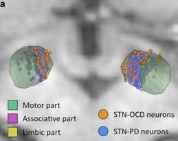 OCD has a Neurophysiological Signature Welter ML, et. al.