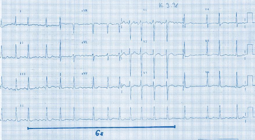 Fig. 11: ECG trace with the irregular heart action, we marked the 6 seconds segment and counted the QRS complexes, then multiplied by 10. (11 QRS x 10 = 110 bmp) 4.