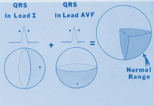 If the QRS complex is positive in lead I and also in lead avf (double thumbs up sign), the vector should point downward
