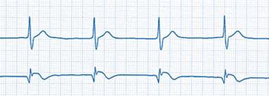 B) HETEROTOPIC ESCAPED RHYTHMS These are the heart rhythms which appear and remain present in case of long lasting inactivity of the SA node.