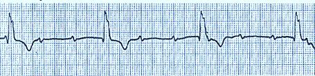 Fig. 28: The upper panel shows ventricular rhythm from the left ventricle with the low heart rate, wide QRS and discordant T.