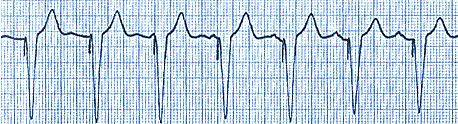 Hemodynamic consequences (low cardiac output) were treated by pacemaker implanted to the ventricular system. Small spikes visible in front of every QRS are the spikes of pacemaker activity.www.
