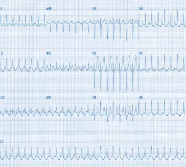 Fig. 30 shows supraventricular tachycardia. Another example of the re-entry tachycardia in the AV nodal zone is that one affecting individuals with the WPW syndrome (Fig. 31).