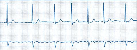 risk of this arrhythmia is that the atria do not have proper contraction; therefore there is not effective emptying of the atria during diastole leading to the risk of thrombosis.