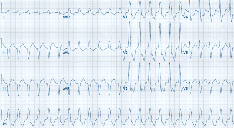 OTHER FORMS OF THE ACTIVE VENTRICULAR HETEROTOPY Doublets (2 PVD), triplets (3 PVD), salvos (4-7 PVD) and episodes of PVD (more than 8 PVC) are clustered premature ventricular depolarizations.