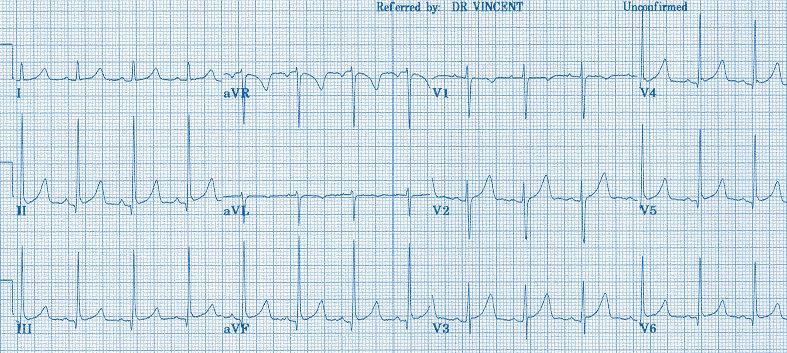 cause of death in these patients is ventricular tachycardia Torsade de Pointes, frequently resulting to ventricular fibrillation.