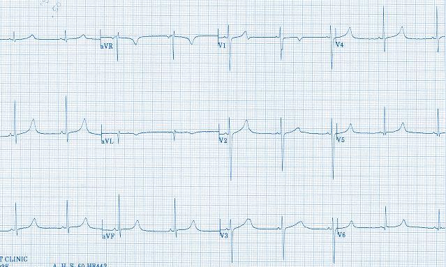 The main mechanisms responsible for this disturbance are dysfunctional K + channels (participating in the repolarization). That s why this process belongs to the channelopathies.