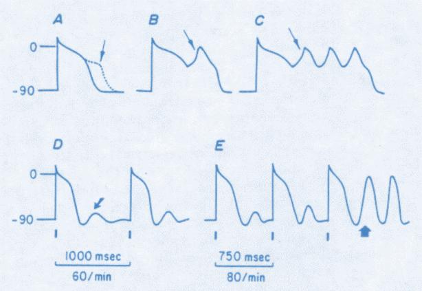 The cause of this phenomenon is a mechanism of early afterdepolarization of the ventricular muscle in the repolarization phase.