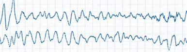 Fig. 44: Ventricular parasystole (Yanowitz FG, 2007) VENTRICULAR FLUTTER This is arrhythmia which is directly endangering the human s life.