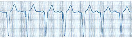 52: The upper panel shows complete AV block with ventricular rhythm (wide, slow (30 bpm) QRS complexes with abnormal configuration).
